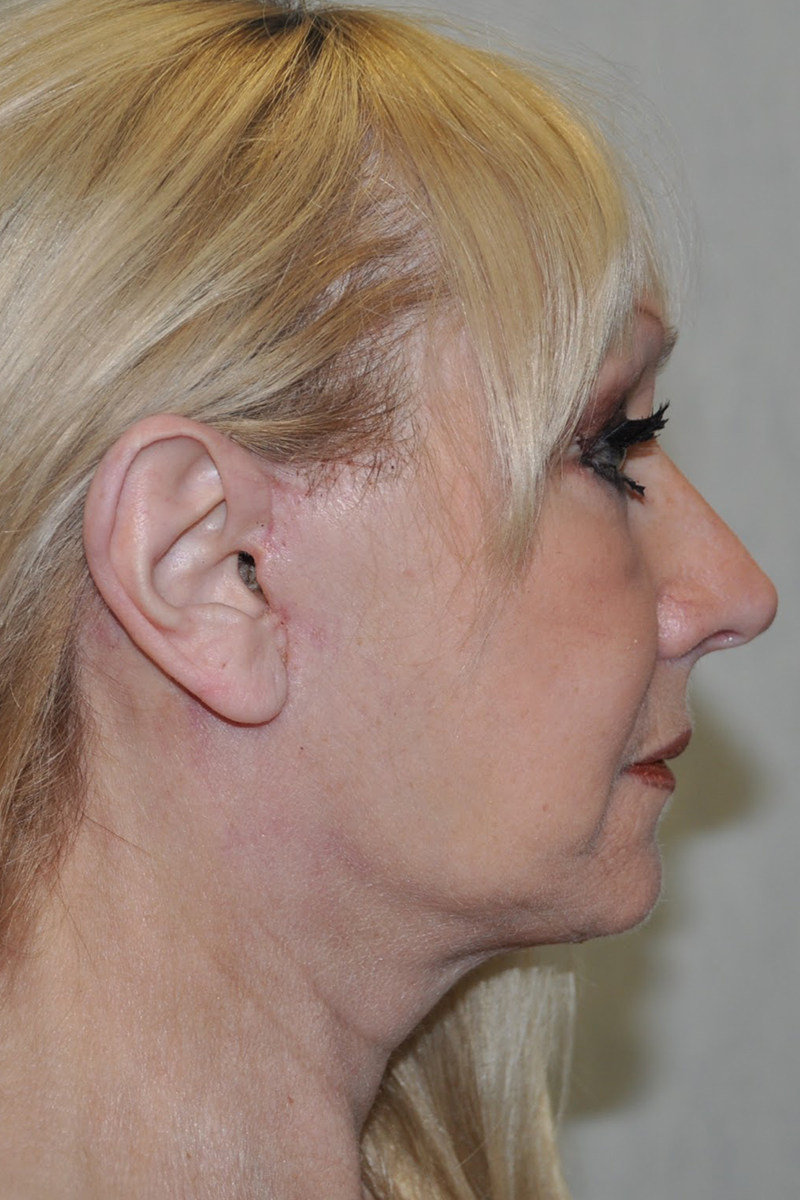 View 3 — after (post-operative)